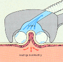 endermologie